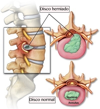 Hernia de Disco Tratamento em Pinheiros